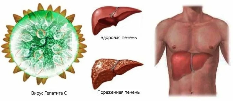 Хронический вирус гепатита С:что важно знать?